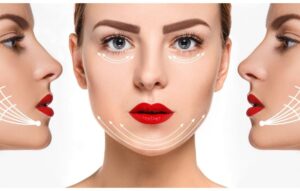 ¿Cuánto tiempo dura el efecto de los hilos tensores en la cara?